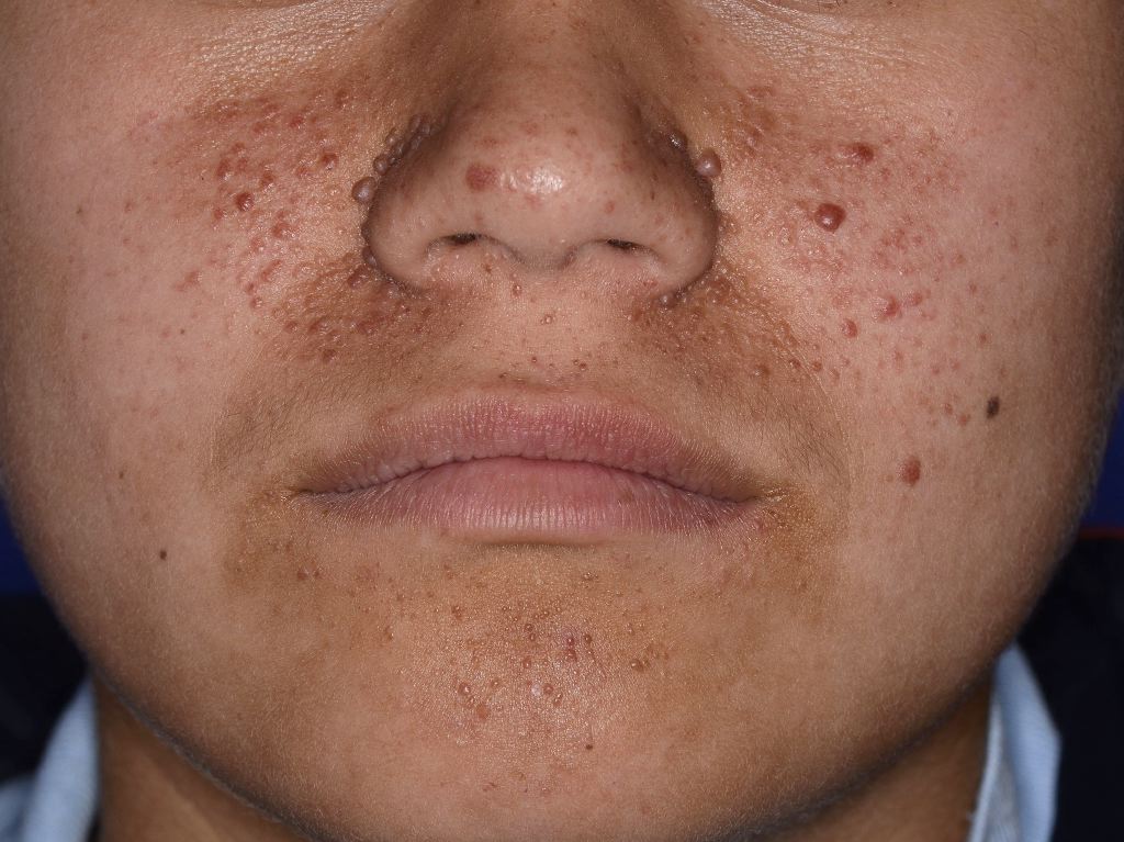 <p>Facial Angiofibromas Observed in Tuberous Sclerosis