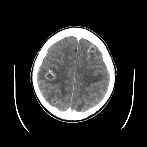 <p>Axial CT Brain With Contrast Abscesses</p>
