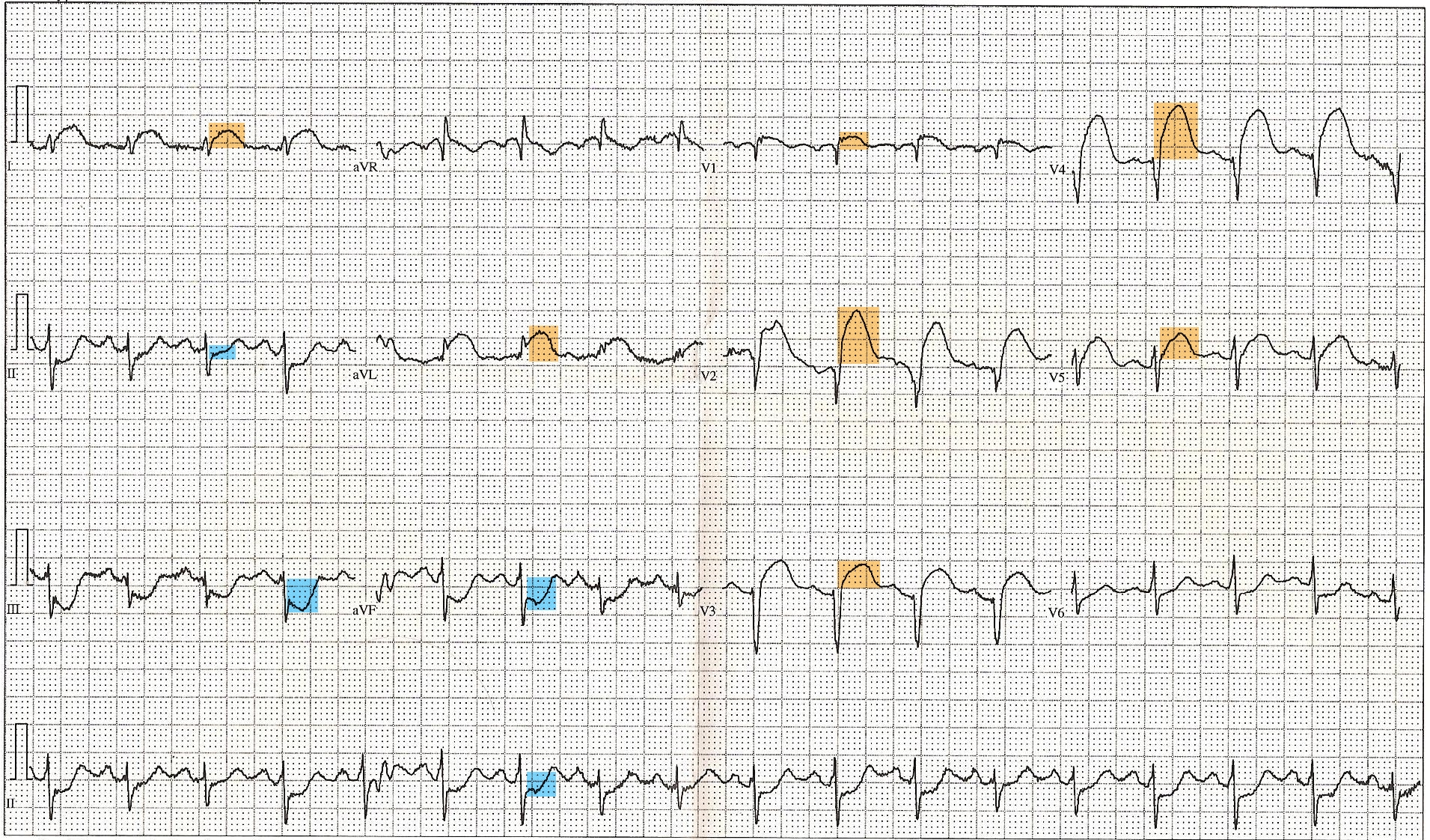 12 Lead ECG EKG showing ST Elevation (STEMI), Tachycardia, Anterior Fascicular Block, Anterior Infarct, Heart Attack