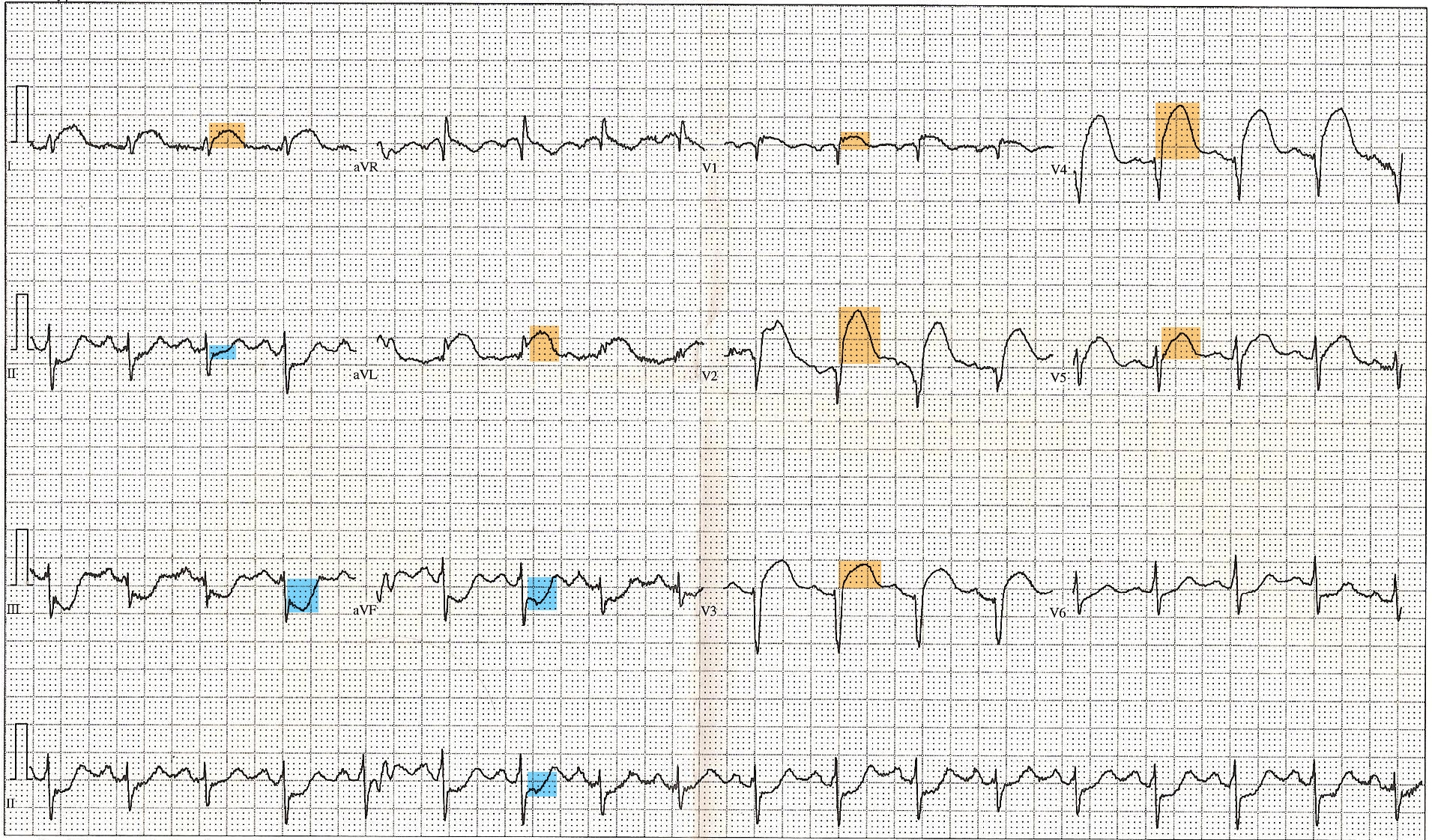 <p>ST-Elevated Myocardial Infarction on ECG