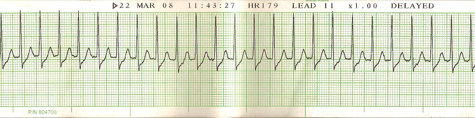 Lead II (2) Supraventricular tachycardia SVT