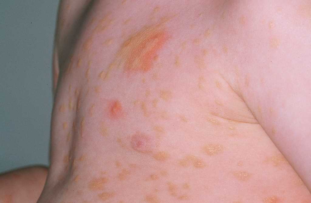 <p>Urticaria Pigmentosa</p>