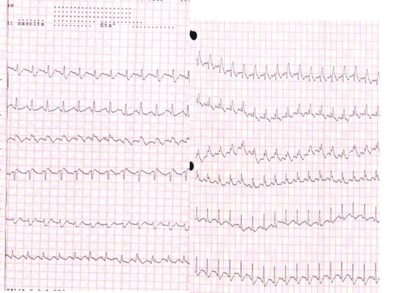 Electrocardiogram of a patient with pulmonary embolism showing sinus tachycardia of approximately 150 beats per minute and right bundle branch block