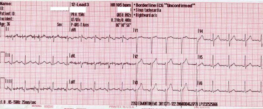 Sinus tachycardia as seen on ECG