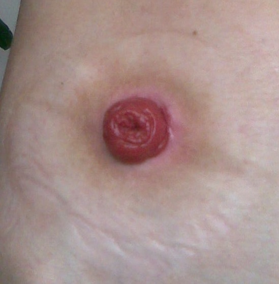 Ileostomy example