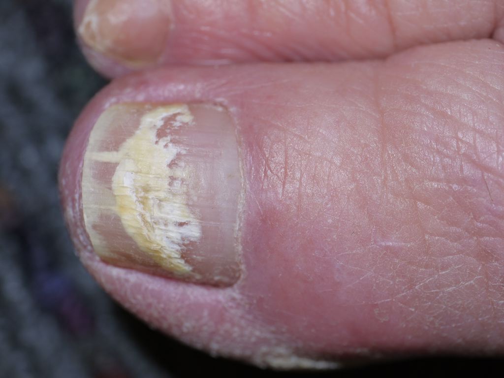 <p>White Superficial Onychomycosis</p>