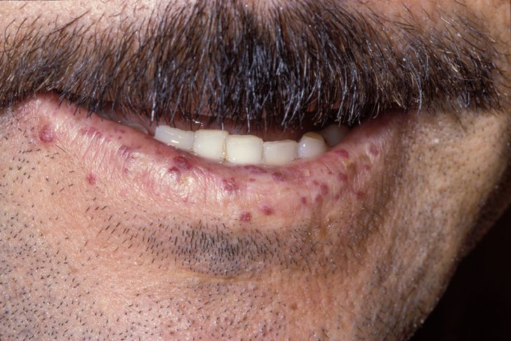 <p>Lip Telangiectasia. The image depicts the presentation of a patient with hereditary hemorrhagic telangiectasia.</p>