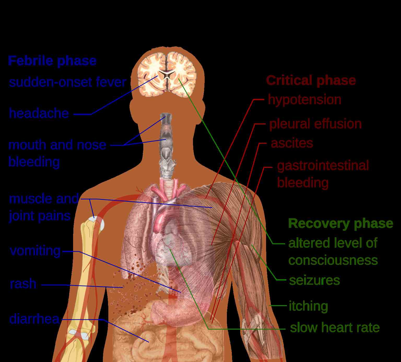 <p>Primary Symptoms of Dengue Fever