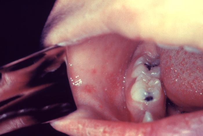 This patient presented on the third pre-eruptive day with “Koplik spots” indicative of the beginning onset of measles