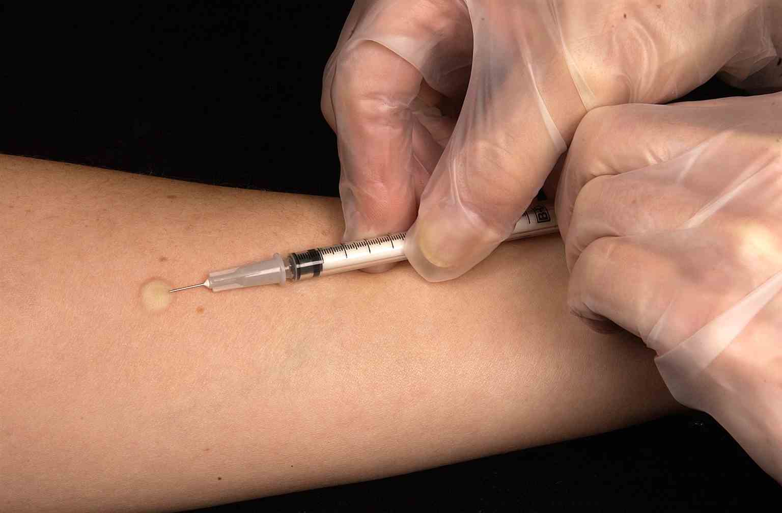 This technician is in the process of correctly placing a Mantoux tuberculin skin test in this recipient’s forearm, which will cause a 6mm to10mm wheal, i
