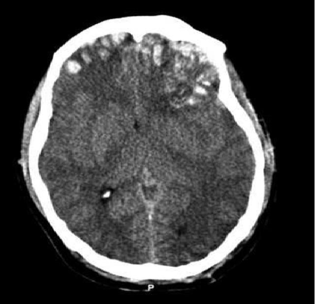 CT scan of patient with brain trauma