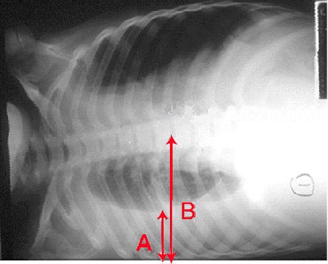 Pleural effusion Chest X-ray of a pleural effusion