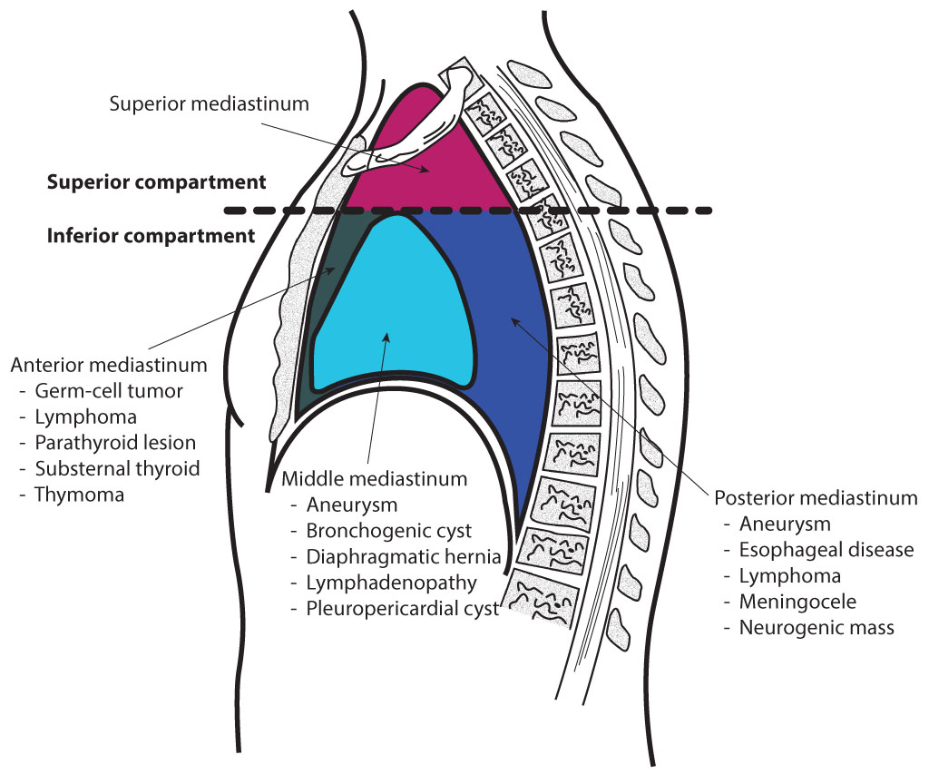 <p>Mediastinal Divisions