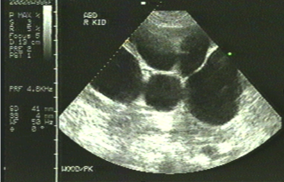 <p>Polycystic Kidney</p>