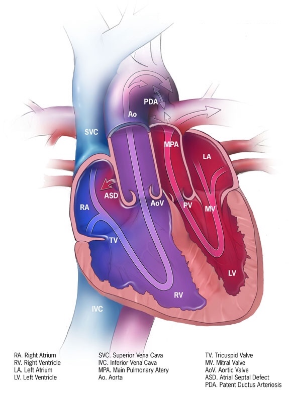 <p>Dextro-Transposition of the Great Arteries (d-TGA)</p>