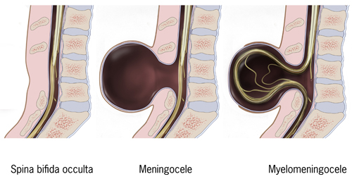 Types of spina bifida