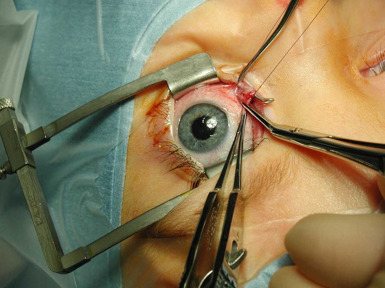 <p>Strabismus Surgery