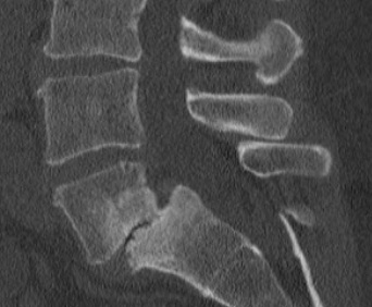 <p>Grade II Spondylolisthesis, CT. Lumbar spine sagittal CT of L5-S1 revealing grade II spondylolisthesis.</p>