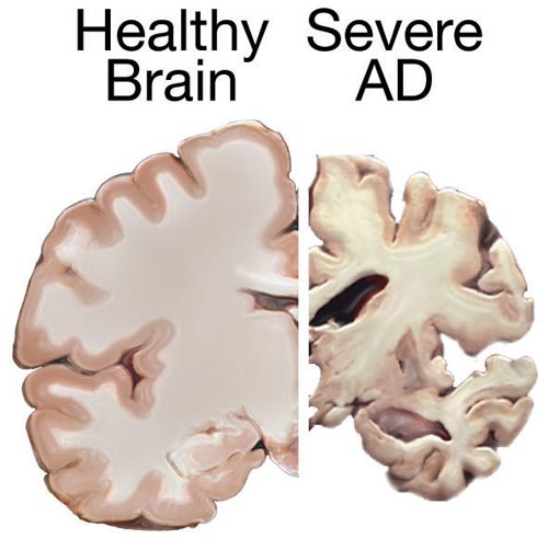 Health Versus AD Brain