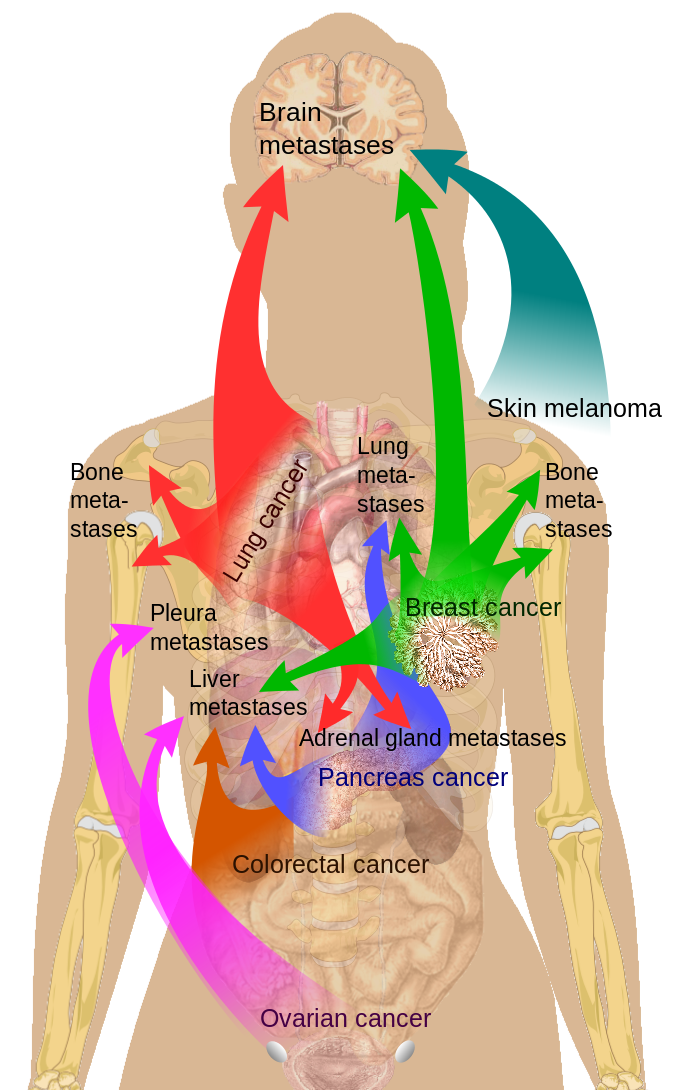 Main sites of metastases for common cancer types, Brain, Skin Melanoma, Bone Metastases, Lung Metastases, Breast Cancer, Adre