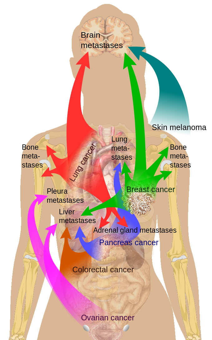 <p>Breast Cancer Metastasis Sites</p>