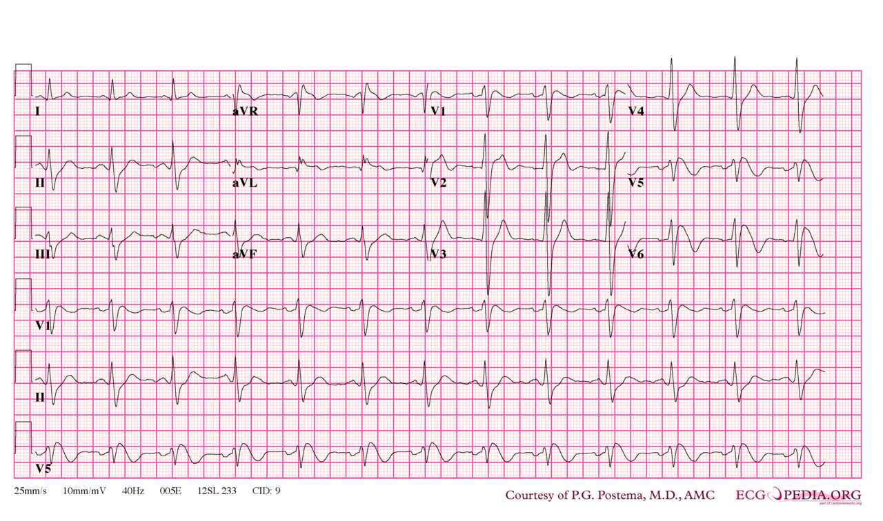 Brugada syndrome type 1