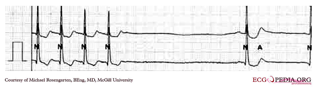 This is a recording of the termination of a supraventricular tachycardia at about 130/min