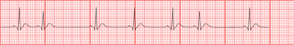 A drawn image of premature atrial contraction (PAC) on II-lead ECG.