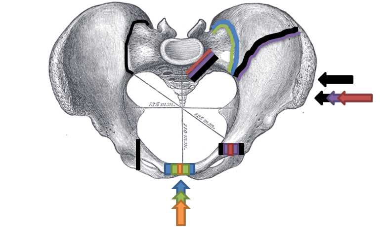 Superior view, Pelvic Fracture Types/Force and break are shown by matching letter and color: A