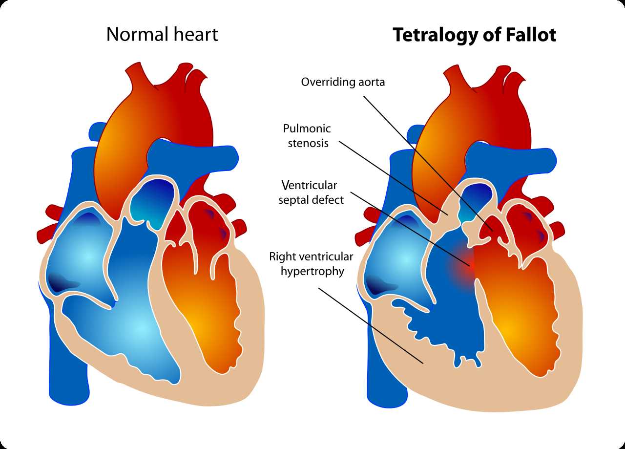 <p>Tetralogy of Fallot