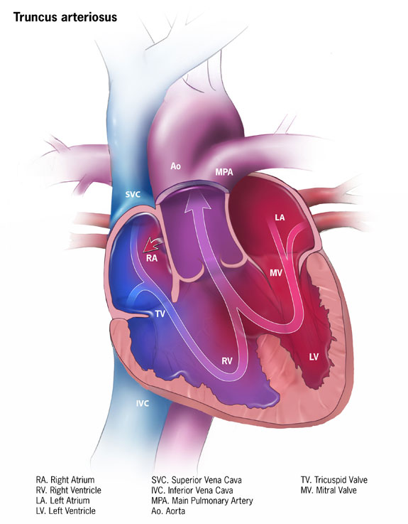 Illustration of Truncus Arteriosus, Heart