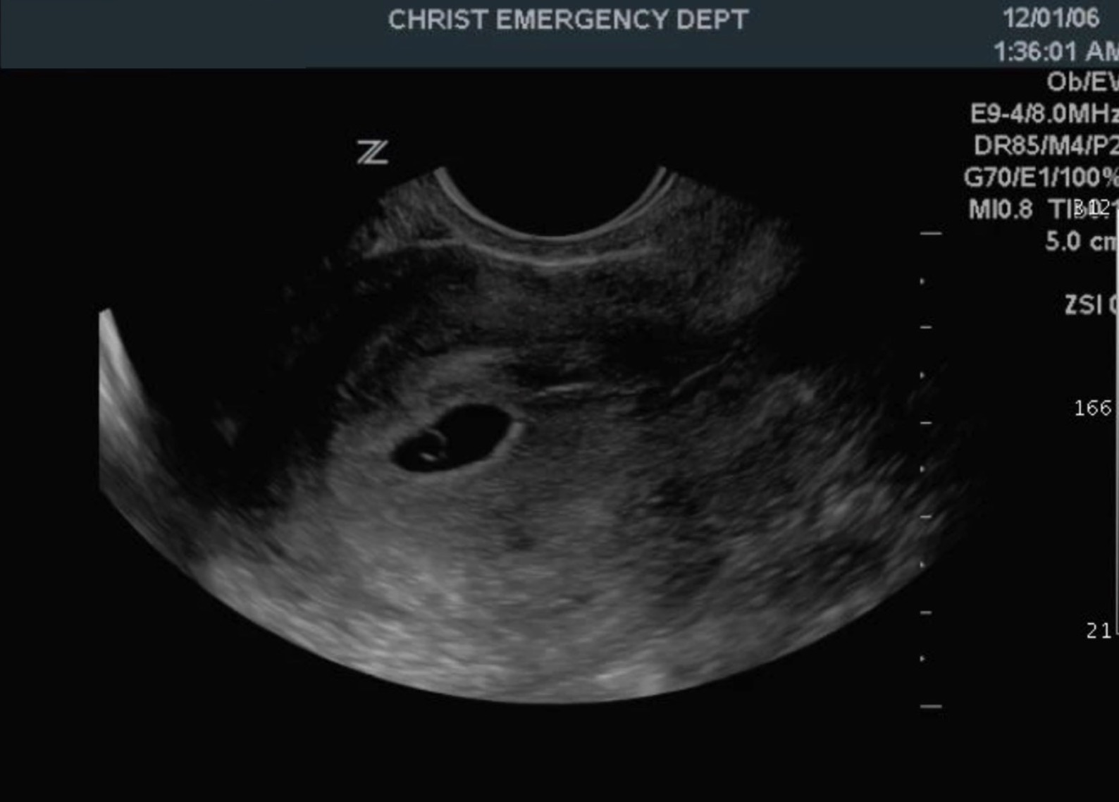 A retroverted uterus with a gestational sac (GS) within the endometrial echo of the uterus and contains a yolk sac (YS).