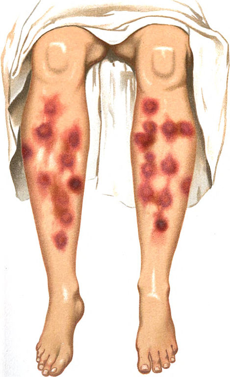 <p>Erythema Nodosum</p>