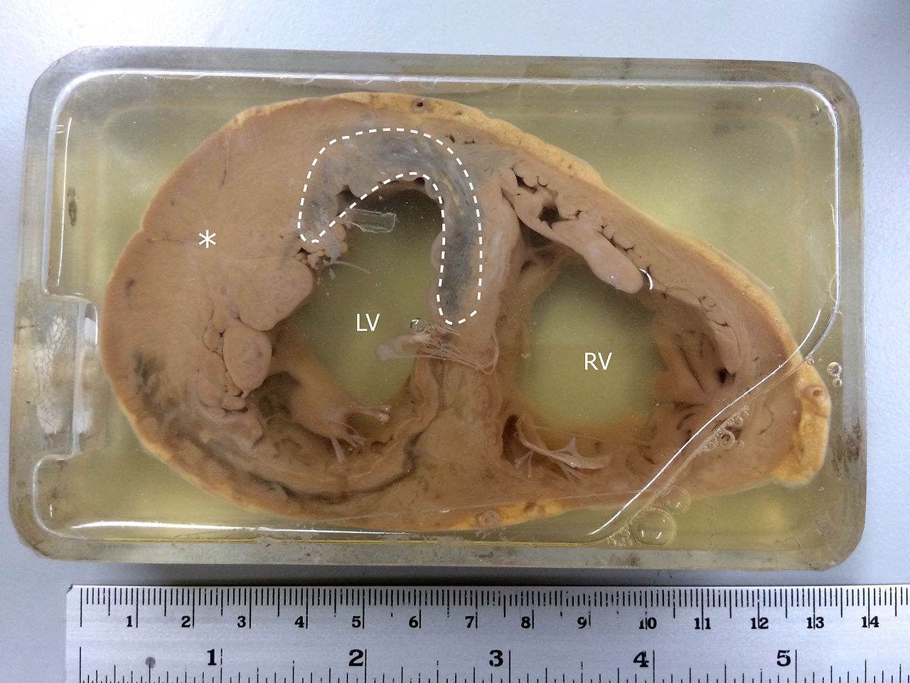 <p>Specimen Showing Myocardial Infarction