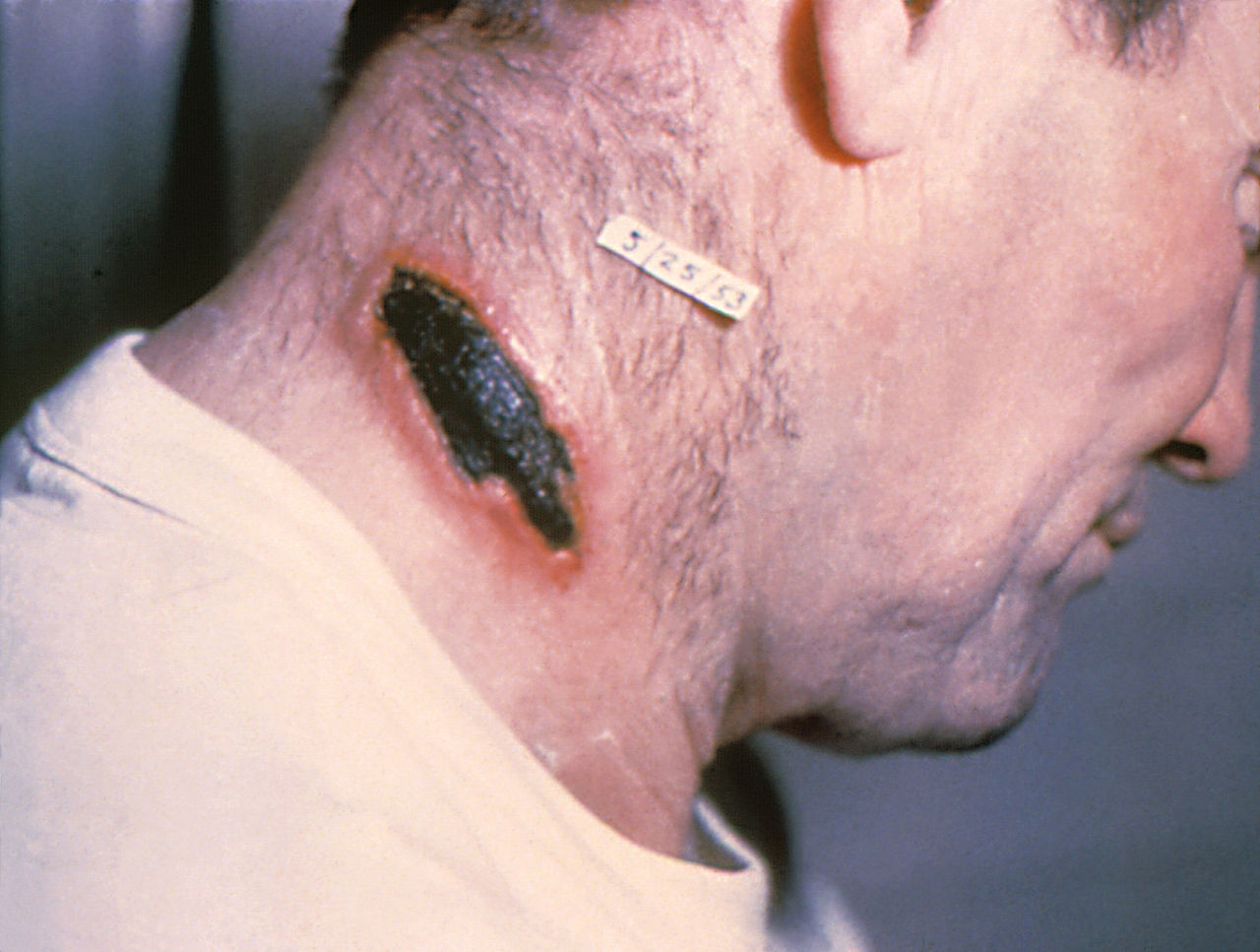 Cutaneous Anthrax lesion on the neck.