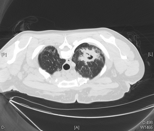 CT Scan, Computerized Tomography, Cavity Tuberculosis, Pulmonary Scan