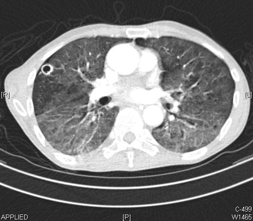 Lung Abscess, CT Scan, Computer Tomography, Thick-walled cavitary lesion in the right lung is an abscess, Diffuse ground glas