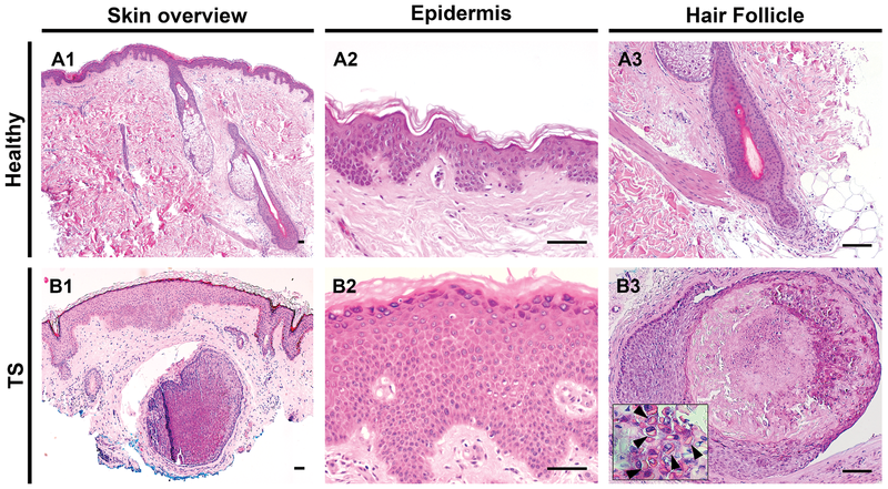 <p>Histology, Trichodysplasia Spinulosa