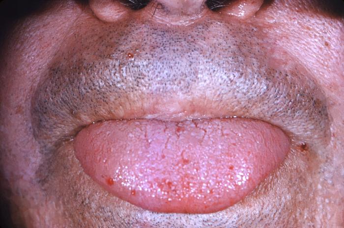 <p>Telangiectasia on the Tongue