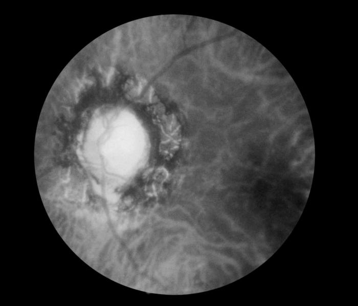 Fundoscopic image, effect of late neuro-ocular syphilis on the optic disk and retina, Pathology, Severe optic nerve atrophy, 