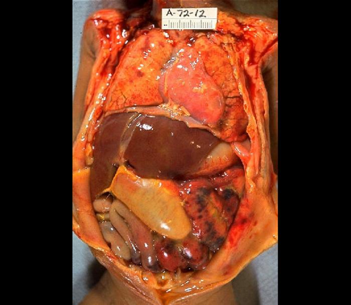 Gross Pathology of neonatal necrotizing enterocolitis, Autopsy, infant, abdominal distention, necrosis, hemorrhage, peritonit