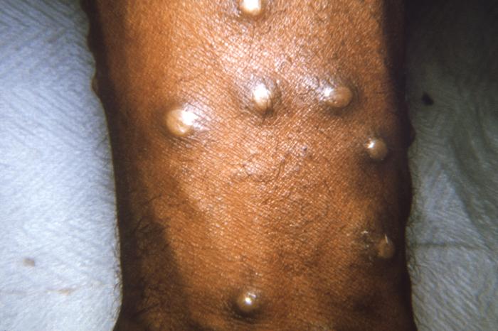 Pathology, Maculopapular lesions, arm, Smallpox Virus, Pustular phase, Variola major and minor