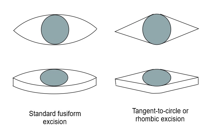 <p>Fusiform Incision and Excision</p>