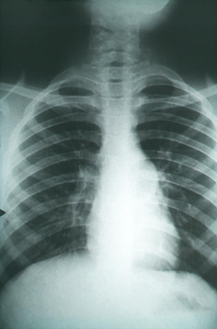Anteroposterior chest x-ray, pulmonary fibrosis, Coccidioidomycosis, fungal organisms, scarring, resembling lung infections i