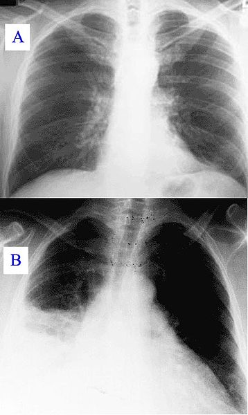 Combination of two x-rays, A represents a normal healthy Chest x-ray, B represents a Chest X-ray documenting Q fever pneumoni