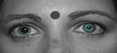 Anisocoria