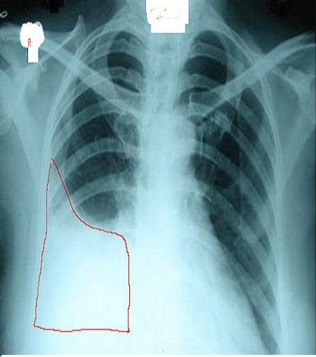 Right Pleural Effusion, X-ray