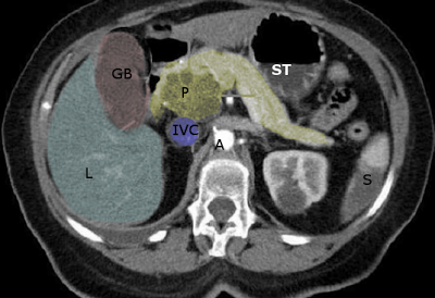 <p>CT Scan L1-L2 Level