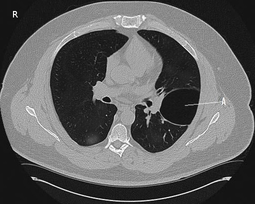 ct bulla, CT Scan, Pneumothorax