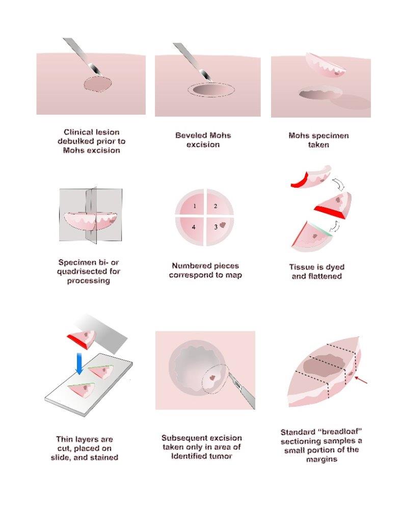 <p>Mohs Surgery Diagram</p>